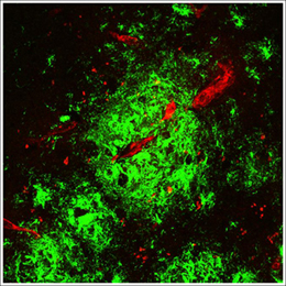 Бета-амилоидные бляшки (зеленые) и сосуды головного мозга (красные) при болезни Альцгеймера.