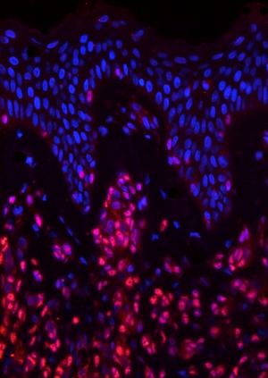 Механизмы, лежащие в основе самого агрессивного рака кожи – меланомы, в значительной степени неизвестны, и эффективных методов ее лечения не существует. На мышиной модели гигантского врожденного невуса и меланомы швейцарские ученые показали, что невус и меланома активно экспрессируют Sox10 – транскрипционный фактор, имеющий решающее значение для образования меланоцитов из клеток нервного гребня. Удивительно, но гаплонедостаточность Sox10 противодействует образованию NrasQ61K-индуцированного врожденного невуса и меланомы без влияния на физиологические функции производных нервного гребня в коже. Кроме того, Sox10 имеет решающее значение для сохранения опухолевых клеток in vivo. У человека практически все врожденные невусы и меланомы Sox10-позитивны. Более того, сайленсинг Sox10 в клетках человеческой меланомы подавляет свойства стволовых клеток нервного гребня, препятствует пролиферации и выживанию клеток и полностью подавляет образование опухолей in vivo. Таким образом, Sox10 представляет собой перспективную мишень для лечения врожденного невуса и меланомы человека. (nature.com). На снимке: фактор транскрипции стволовых клеток Sox10 (красный) активен в опухолевой ткани меланомы и необходим для образования и распространения рака.